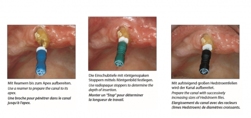 Endodontic 1